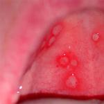Млечница в устата при кърмачета - лечение, причини и признаци