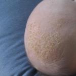Кора на главата на новородено: трябва ли да се тревожа и как да я премахна?